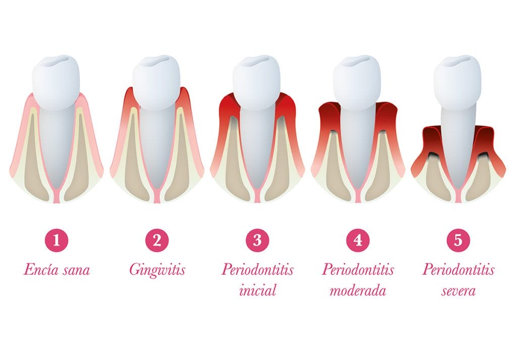 periodontitis