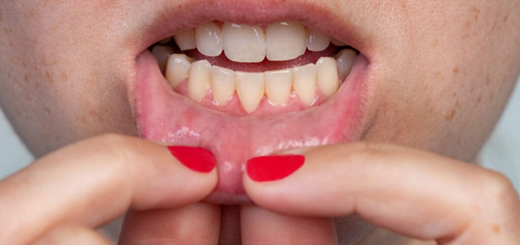 periodontitis